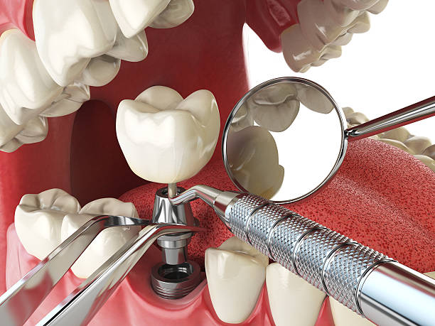 Best Emergency Tooth Extraction in Paris, IL